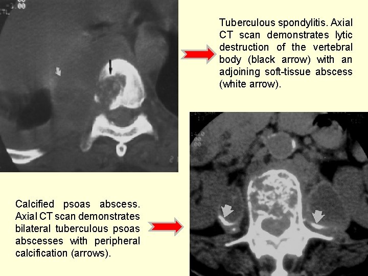  Tuberculous spondylitis. Axial CT scan demonstrates lytic destruction of the vertebral body (black