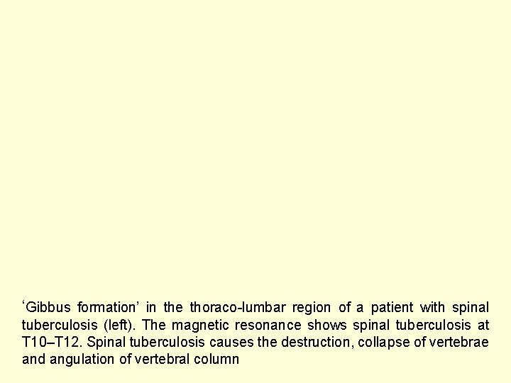 ‘Gibbus formation’ in the thoraco-lumbar region of a patient with spinal tuberculosis (left). The