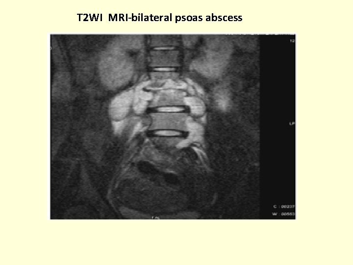 T 2 WI MRI-bilateral psoas abscess 