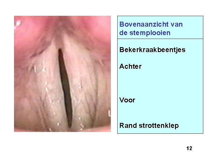 Bovenaanzicht van de stemplooien Bekerkraakbeentjes Achter Voor Rand strottenklep 12 