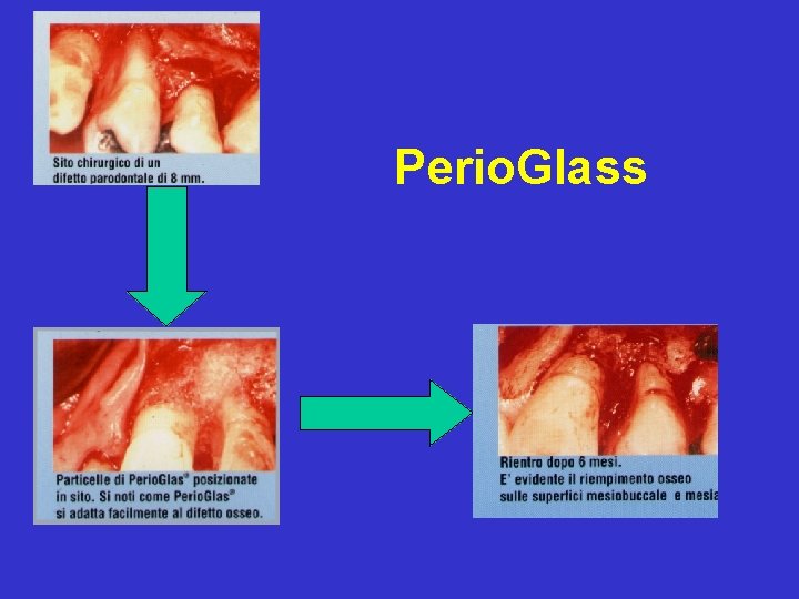 Perio. Glass 