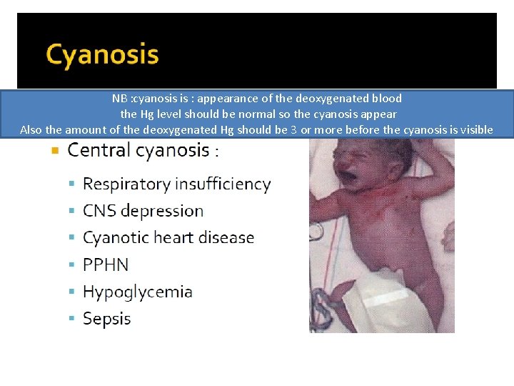 NB : cyanosis is : appearance of the deoxygenated blood the Hg level should