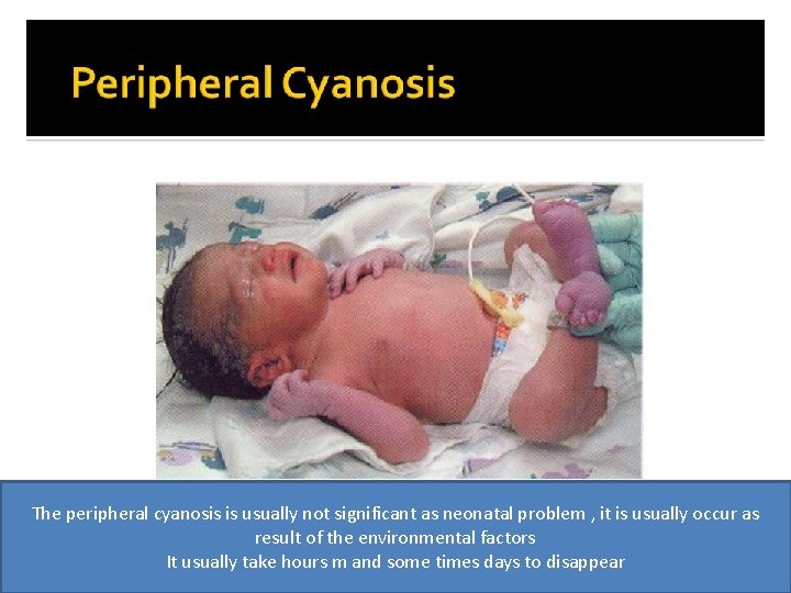 The peripheral cyanosis is usually not significant as neonatal problem , it is usually