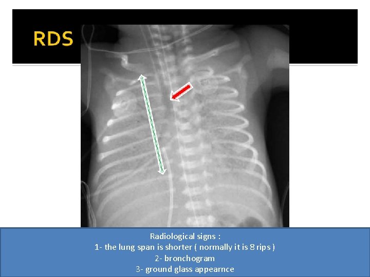 Radiological signs : 1 - the lung span is shorter ( normally it is