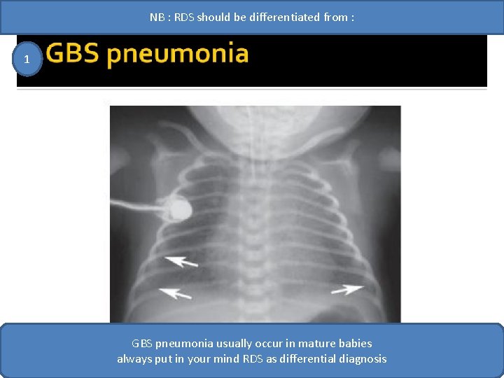 NB : RDS should be differentiated from : 1 GBS pneumonia usually occur in