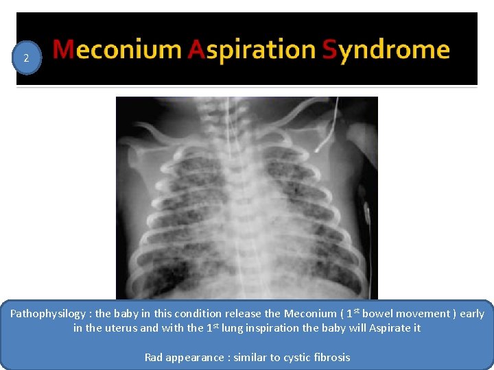 2 Pathophysilogy : the baby in this condition release the Meconium ( 1 st