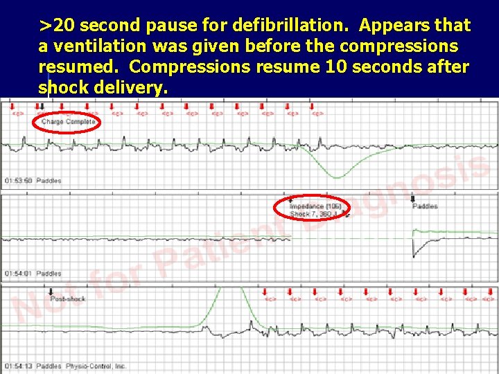 >20 second pause for defibrillation. Appears that a ventilation was given before the compressions