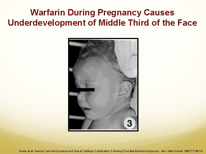 Warfarin During Pregnancy Causes Underdevelopment of Middle Third of the Face Howe et al.