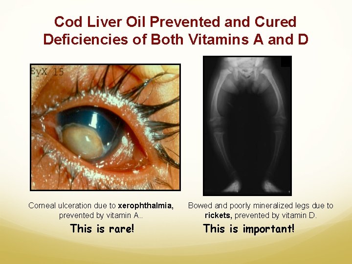 Cod Liver Oil Prevented and Cured Deficiencies of Both Vitamins A and D Corneal