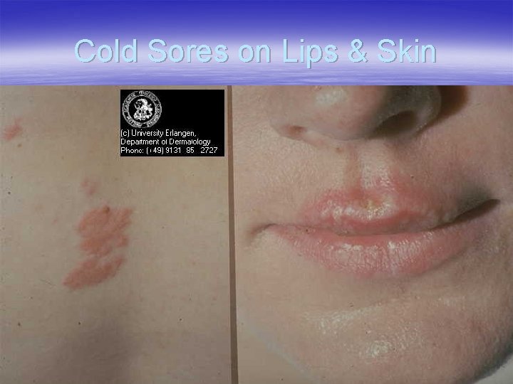Cold Sores on Lips & Skin 