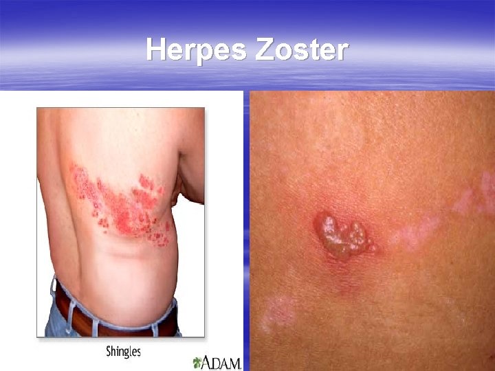 Herpes Zoster 
