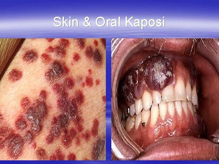 Skin & Oral Kaposi 
