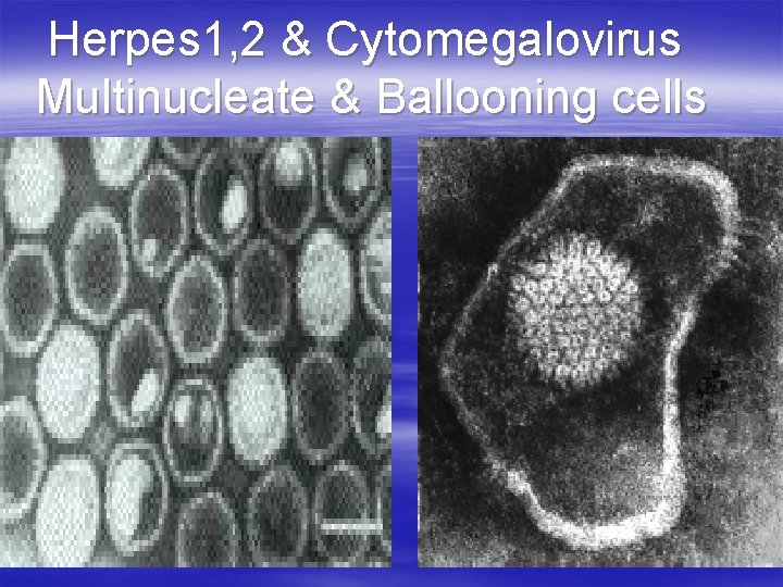 Herpes 1, 2 & Cytomegalovirus Multinucleate & Ballooning cells 