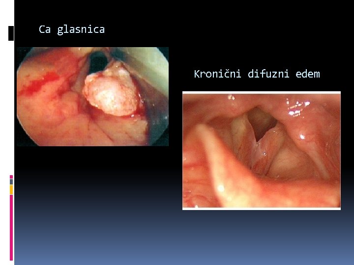 Ca glasnica Kronični difuzni edem 