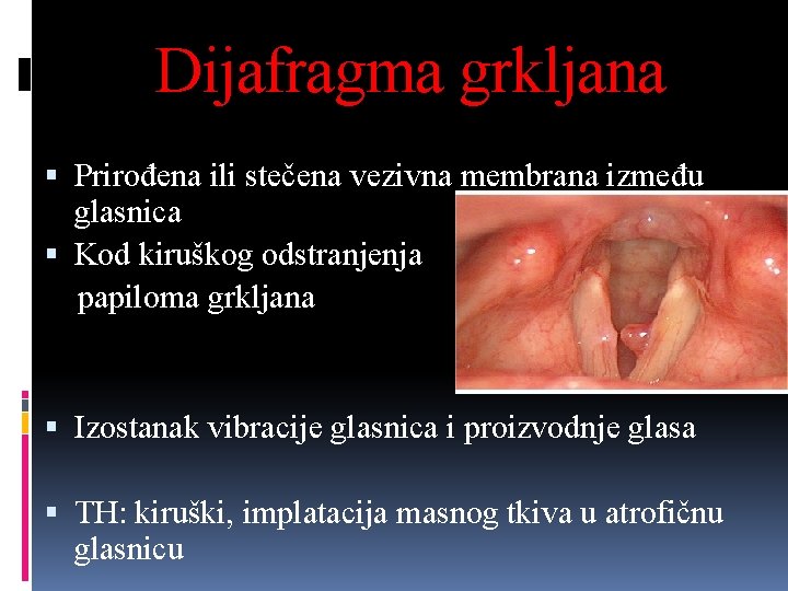 Dijafragma grkljana Prirođena ili stečena vezivna membrana između glasnica Kod kiruškog odstranjenja papiloma grkljana