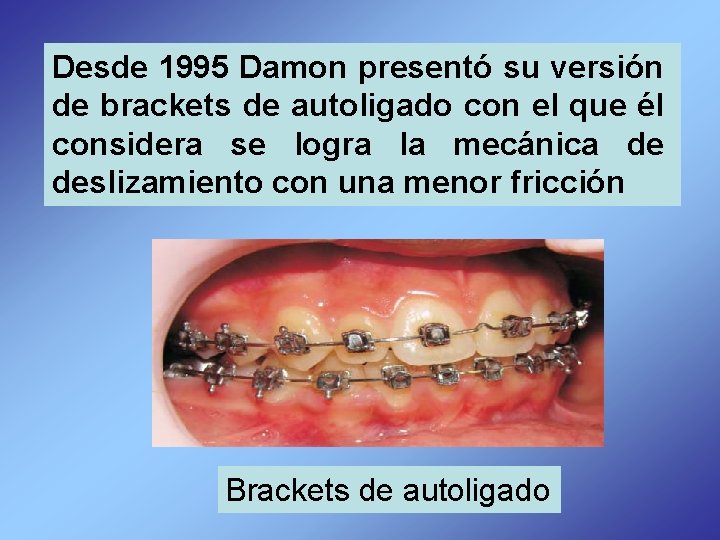Desde 1995 Damon presentó su versión de brackets de autoligado con el que él