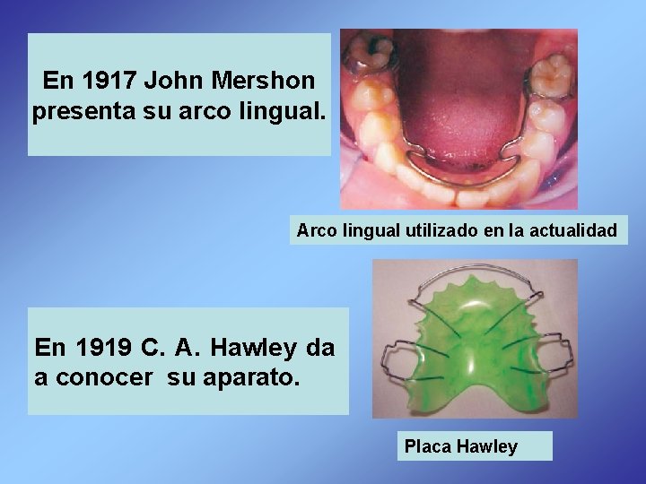 En 1917 John Mershon presenta su arco lingual. Arco lingual utilizado en la actualidad