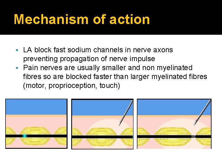 Mechanism of action LA block fast sodium channels in nerve axons preventing propagation of
