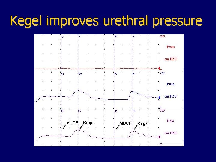 Kegel improves urethral pressure 