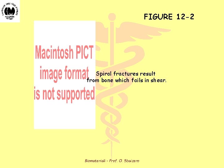 FIGURE 12 -2 Spiral fractures result from bone which fails in shear. Biomateriali -