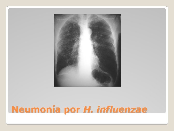 Neumonía por H. influenzae 