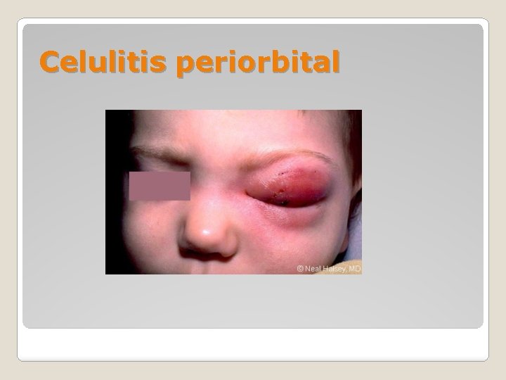 Celulitis periorbital 