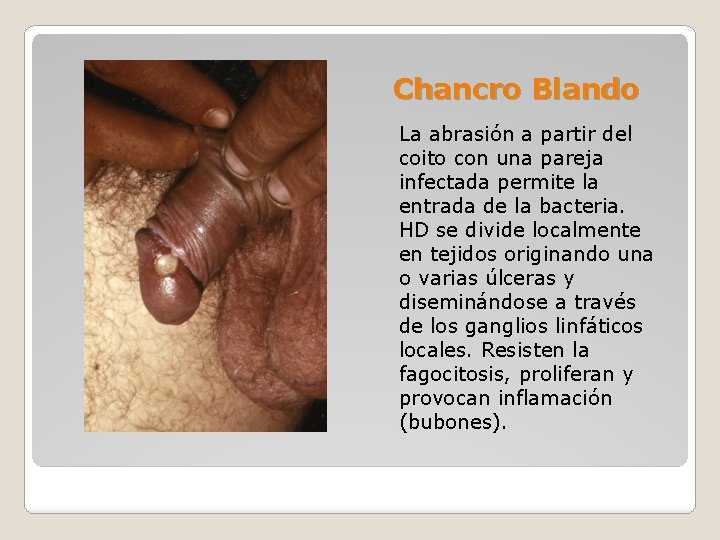 Chancro Blando La abrasión a partir del coito con una pareja infectada permite la