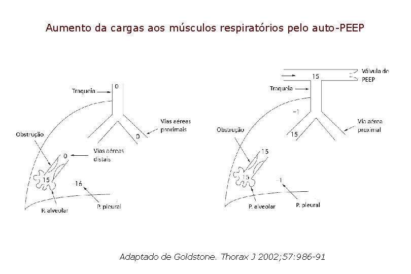 Aumento da cargas aos músculos respiratórios pelo auto-PEEP Adaptado de Goldstone. Thorax J 2002;