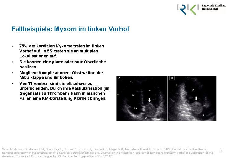 Fallbeispiele: Myxom im linken Vorhof • • 75% der kardialen Myxome treten im linken