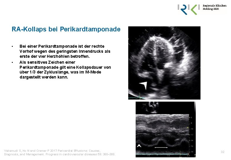 RA-Kollaps bei Perikardtamponade • • Bei einer Perikardtamponade ist der rechte Vorhof wegen des