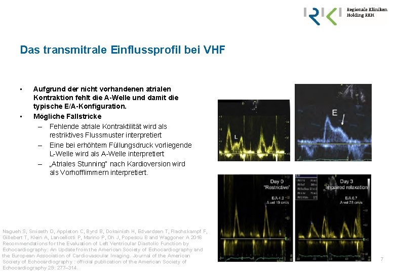 Das transmitrale Einflussprofil bei VHF • • Aufgrund der nicht vorhandenen atrialen Kontraktion fehlt