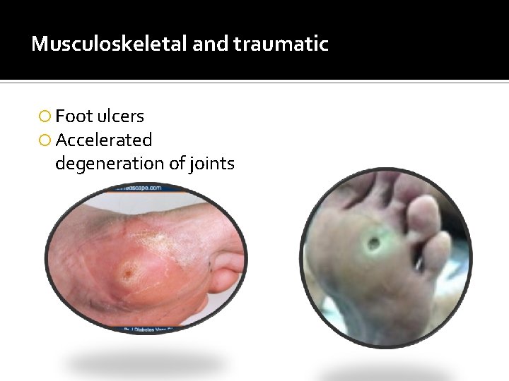 Musculoskeletal and traumatic Foot ulcers Accelerated degeneration of joints 