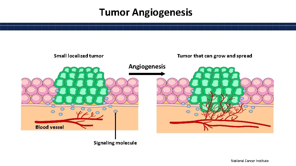 Tumor Angiogenesis Small localized tumor Tumor that can grow and spread Angiogenesis Blood vessel