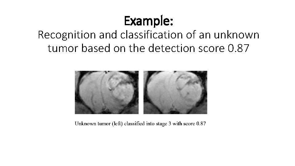 Example: Recognition and classification of an unknown tumor based on the detection score 0.