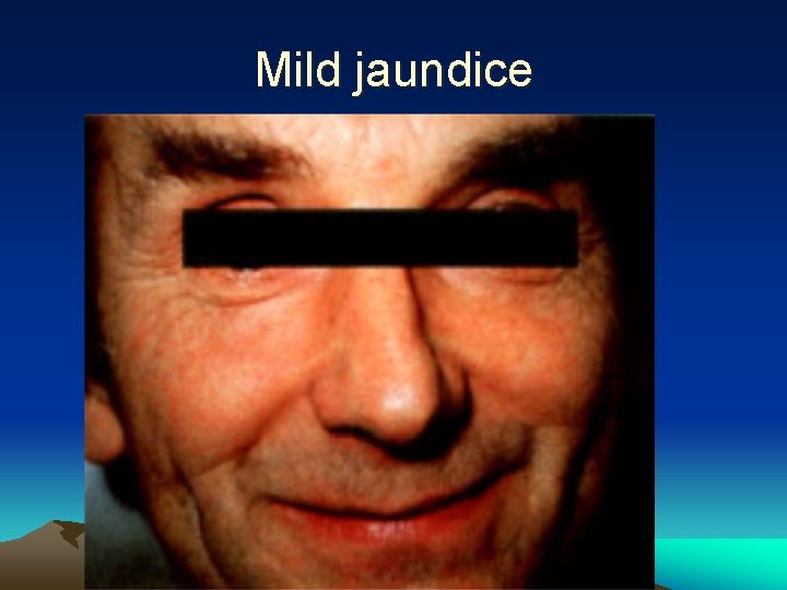 Mild jaundice 