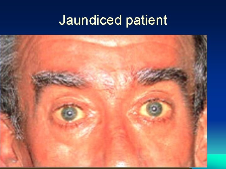 Jaundiced patient 