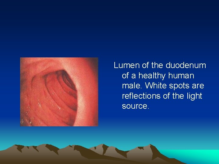 Lumen of the duodenum of a healthy human male. White spots are reflections of
