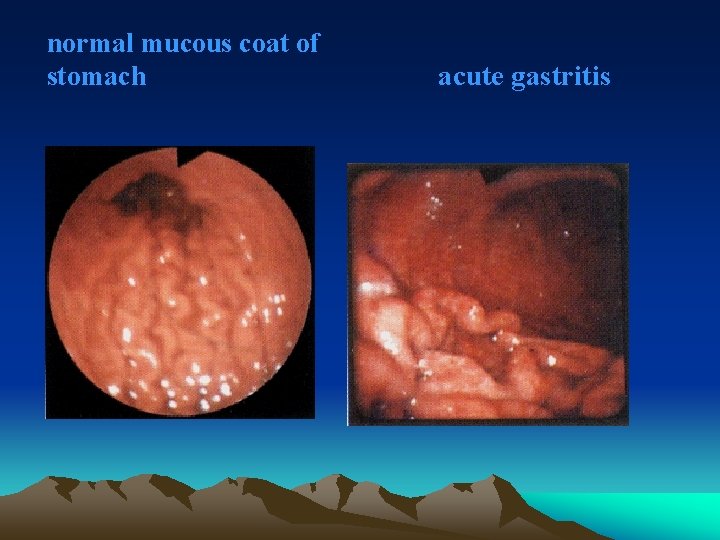 normal mucous coat of stomach acute gastritis 