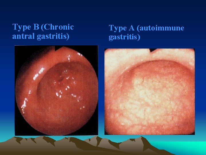 Type B (Chronic antral gastritis) Type A (autoimmune gastritis) 