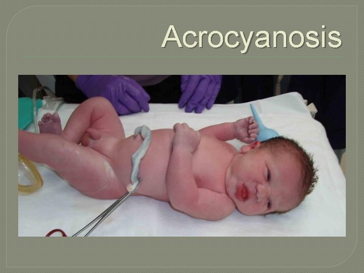 Acrocyanosis 