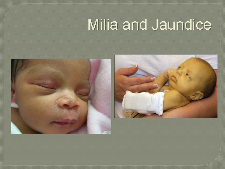 Milia and Jaundice 