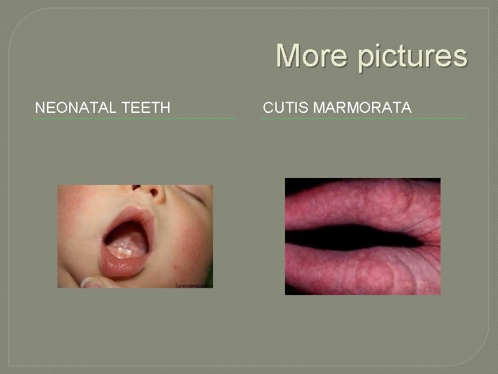 More pictures NEONATAL TEETH CUTIS MARMORATA 