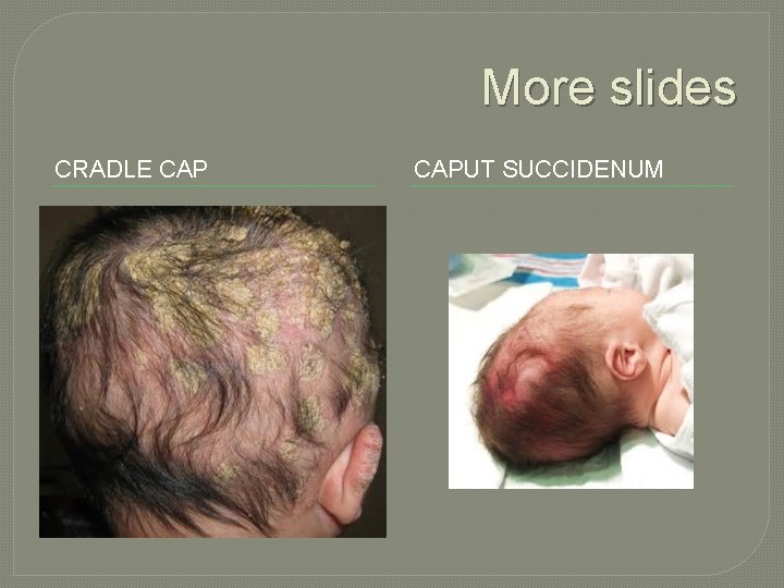 More slides CRADLE CAPUT SUCCIDENUM 