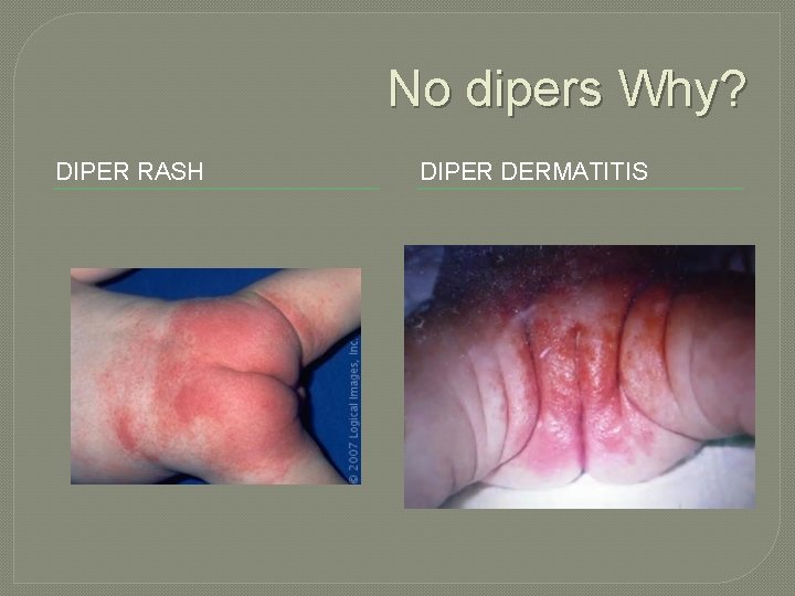 No dipers Why? DIPER RASH DIPER DERMATITIS 