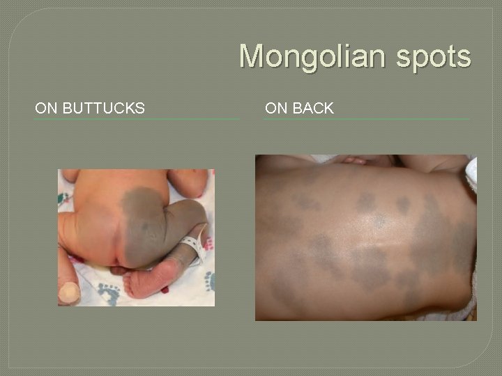 Mongolian spots ON BUTTUCKS ON BACK 