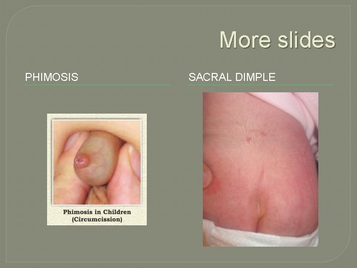 More slides PHIMOSIS SACRAL DIMPLE 