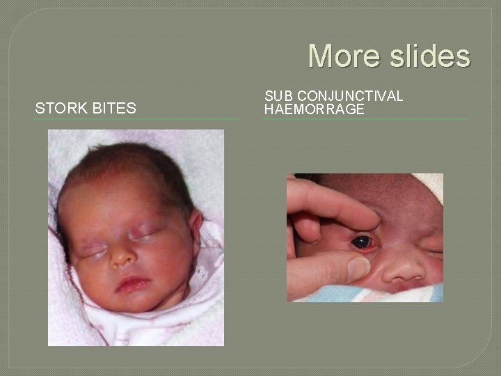 More slides STORK BITES SUB CONJUNCTIVAL HAEMORRAGE 