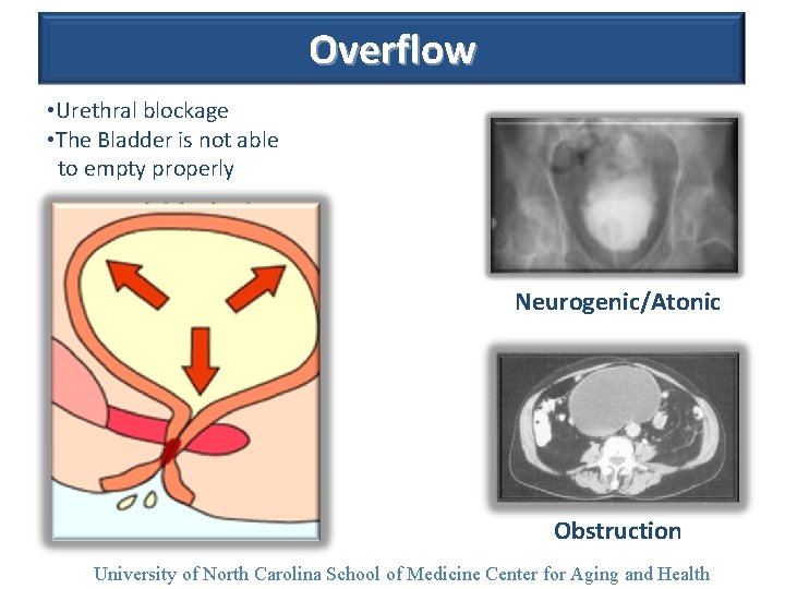Overflow • Urethral blockage • The Bladder is not able to empty properly Neurogenic/Atonic