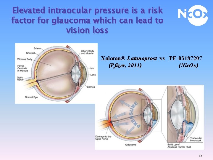 Elevated intraocular pressure is a risk factor for glaucoma which can lead to vision