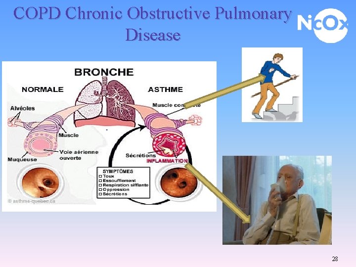 COPD Chronic Obstructive Pulmonary Disease 28 
